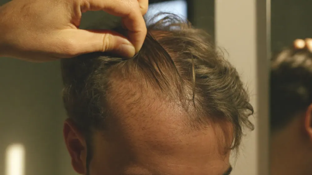Alopecia androgenetica: que es y como se frena
