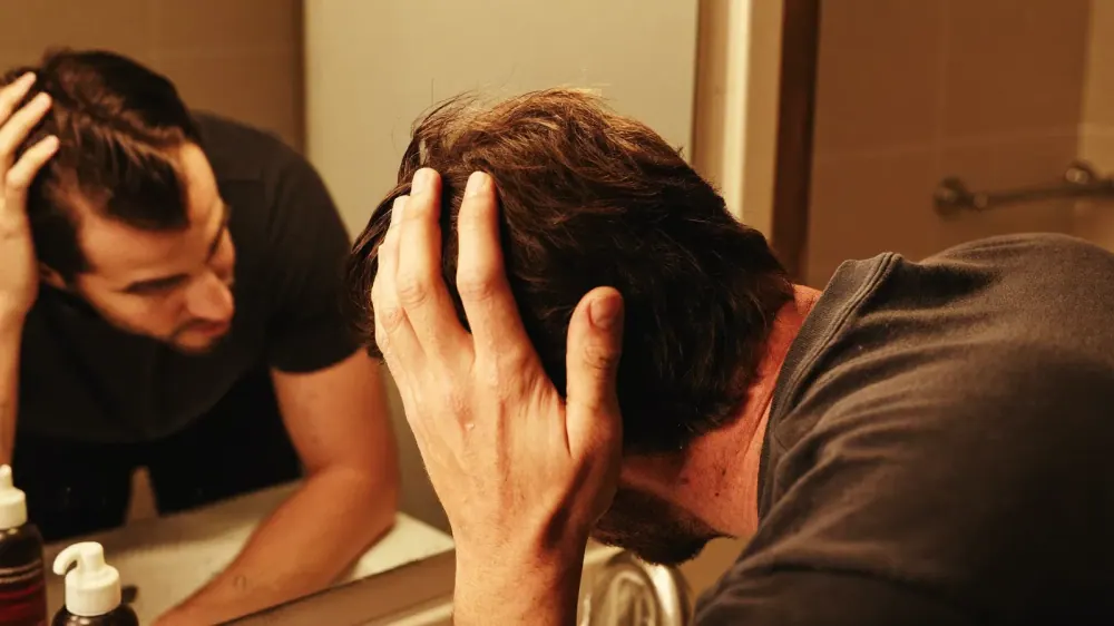 Dermatitis seborreica y caída del pelo: guía práctica